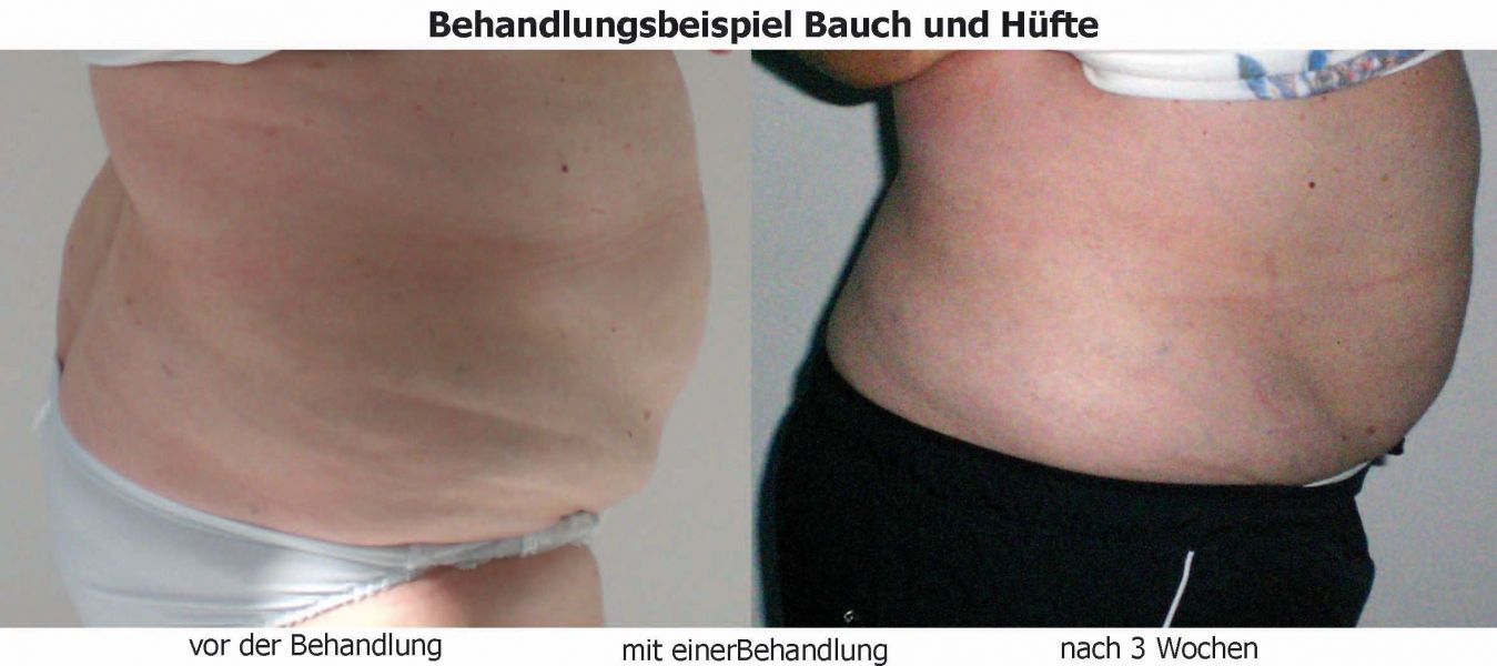 Kryolipolyse - Fettabbau mit Kälte