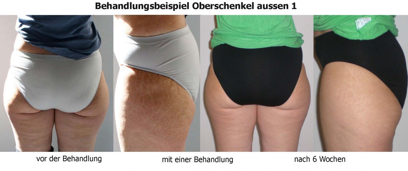 Kryolipolyse - Fettabbau mit Kälte